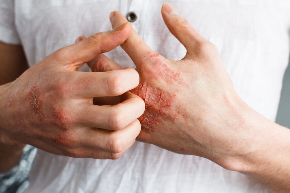 Pathologie de Dermatite de contact